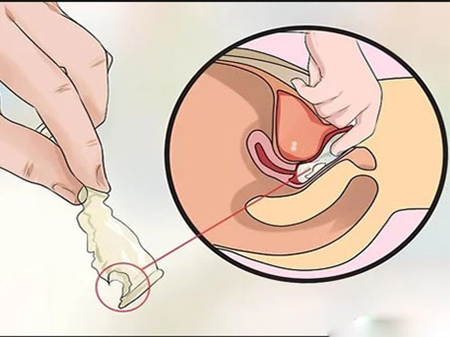بررسی کاندوم پس از خارج کردن از واژن